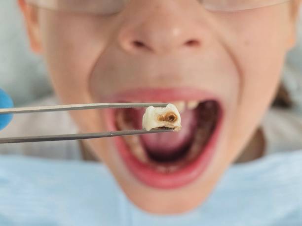 Best Emergency Tooth Extraction in Chico, CA
