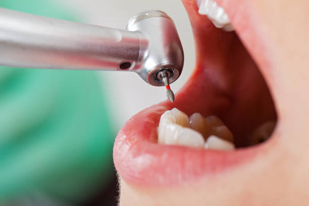 Best Emergency Wisdom Teeth Removal in Chico, CA